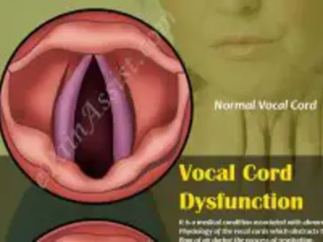 The Connection Between Asthma and Vocal Cord Dysfunction